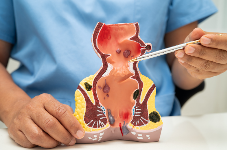 Ureteroscopic Stone Removal